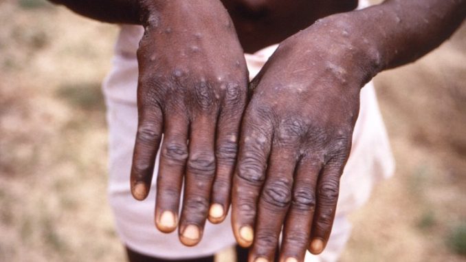 Monkeypox Can Be Transmitted Through x – NCDC Warns
