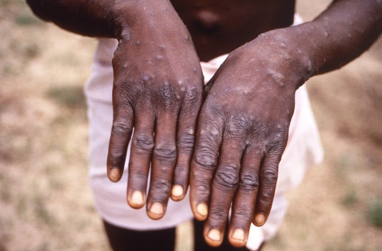 Monkeypox Can Be Transmitted Through $3x – NCDC Warns